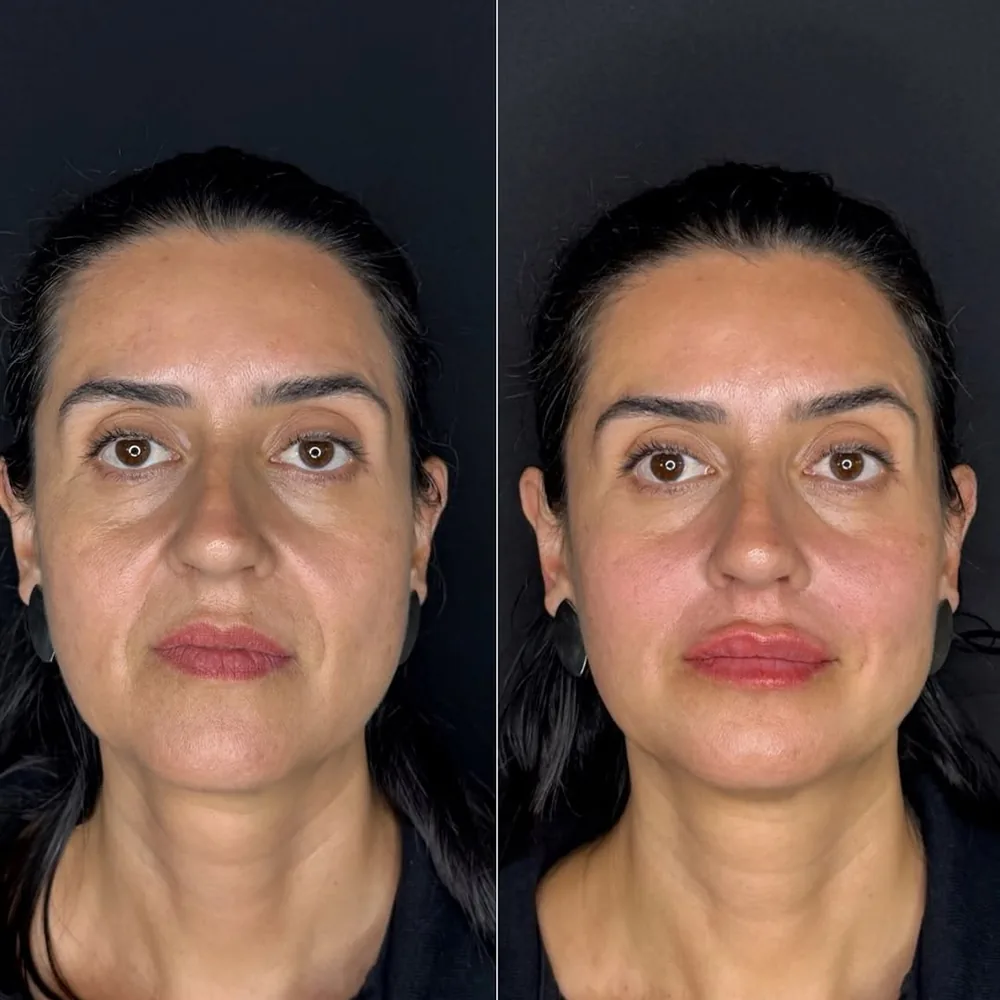 Antes e depois de harmonização facial na Schultz Estética